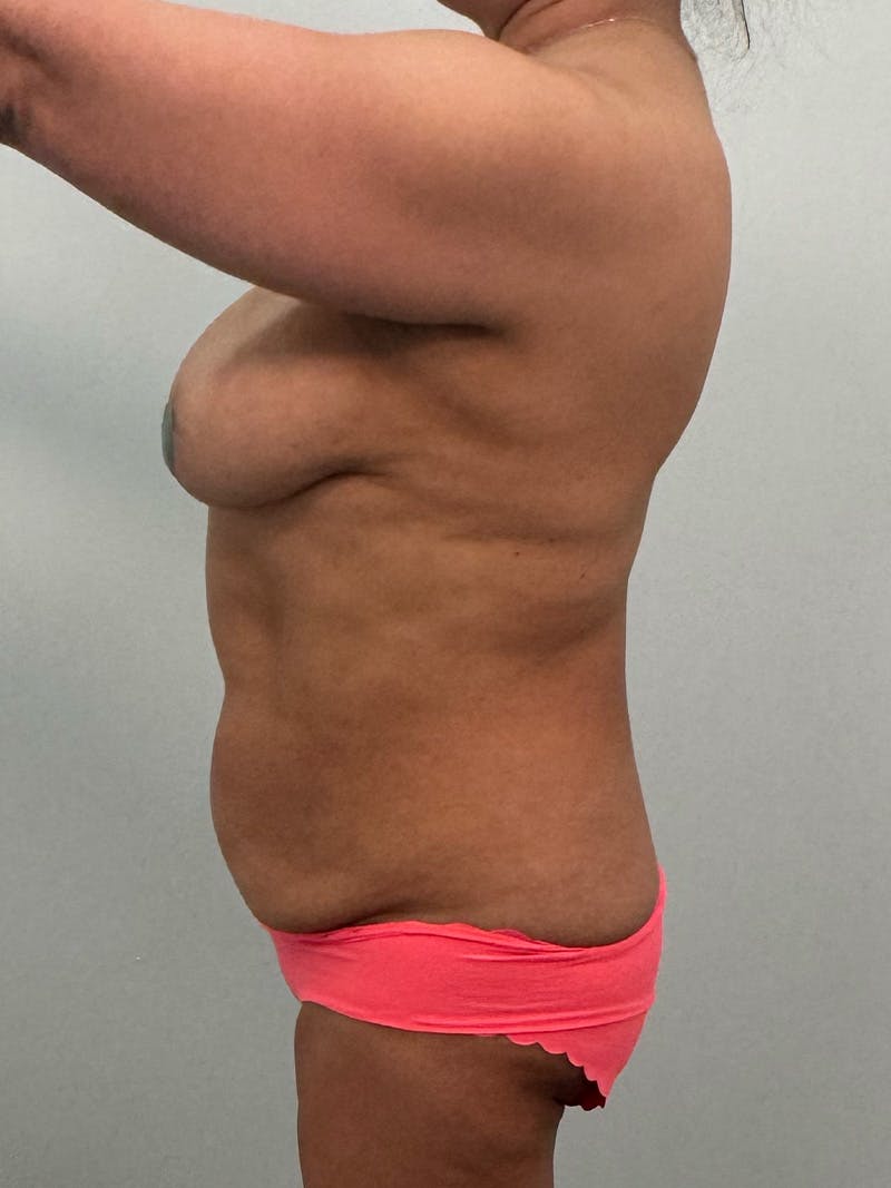 Mommy Makeover Before & After Gallery - Patient 293689 - Image 13