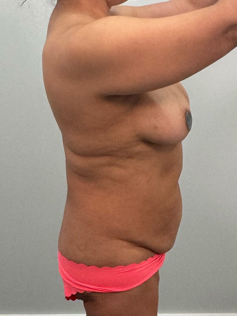 Mommy Makeover Before & After Gallery - Patient 293689 - Image 7