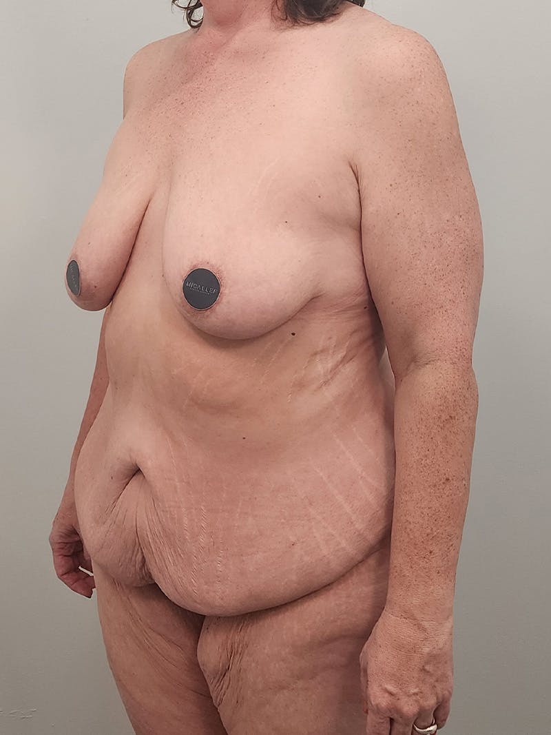 Mommy Makeover Before & After Gallery - Patient 371589 - Image 9