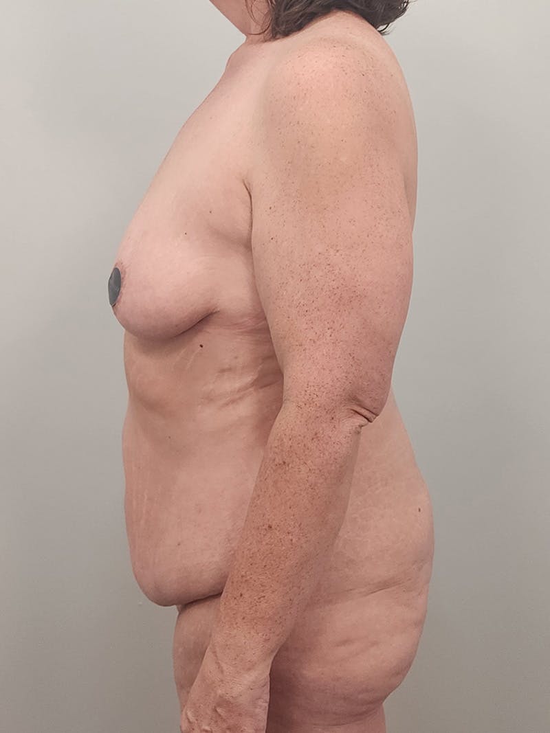 Mommy Makeover Before & After Gallery - Patient 371589 - Image 11