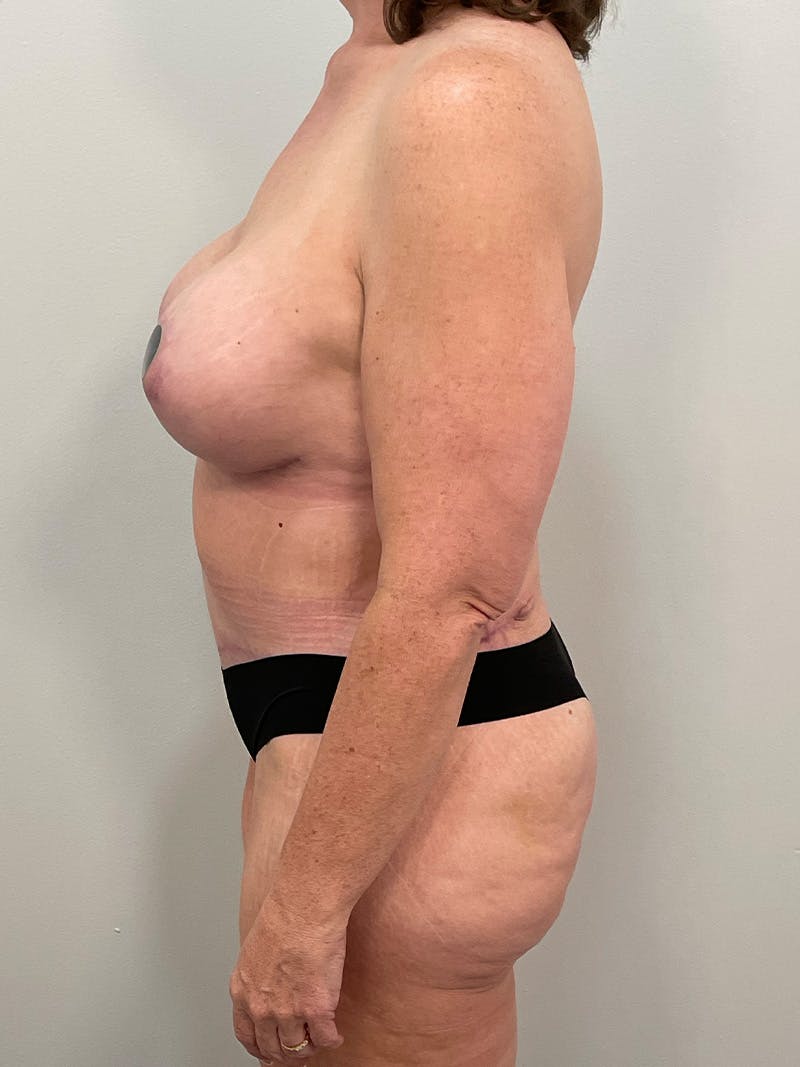 Mommy Makeover Before & After Gallery - Patient 371589 - Image 12