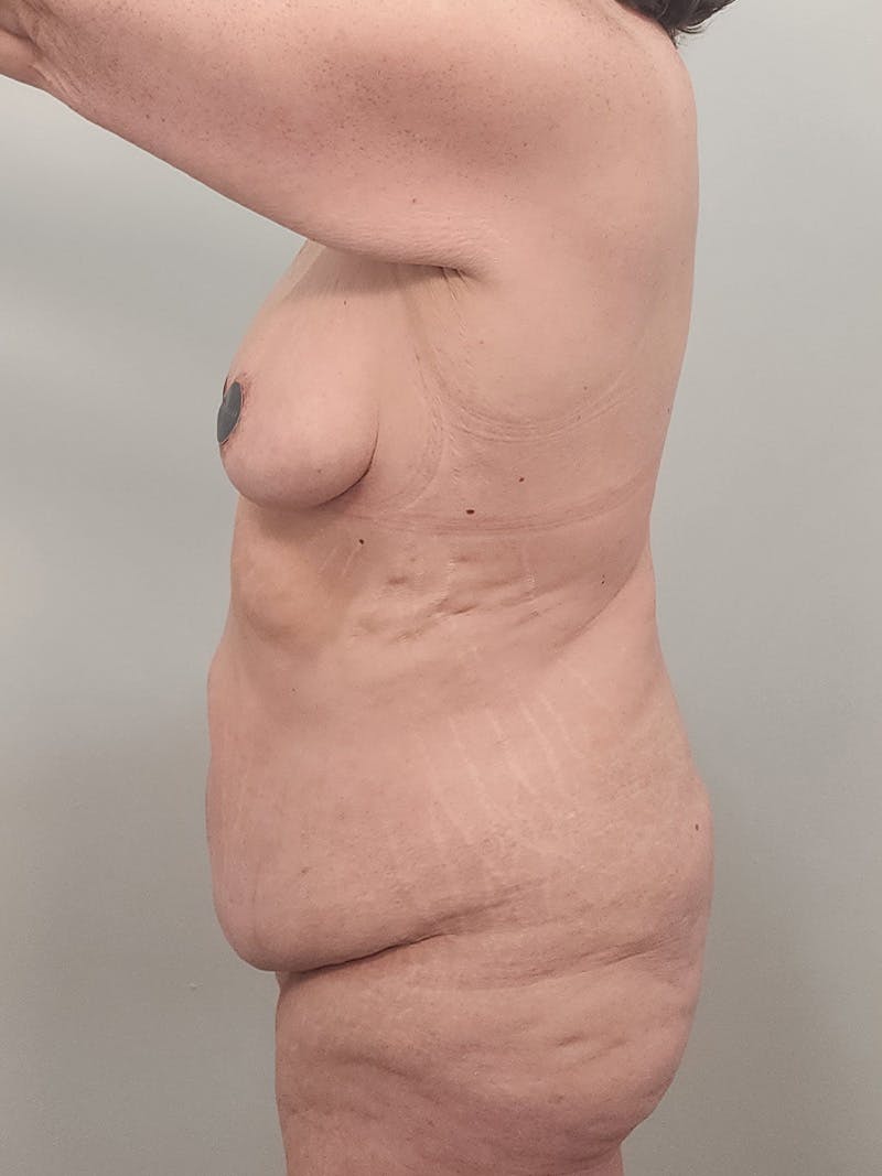 Mommy Makeover Before & After Gallery - Patient 371589 - Image 13