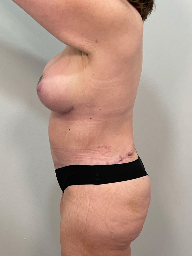 Mommy Makeover Before & After Gallery - Patient 371589 - Image 14