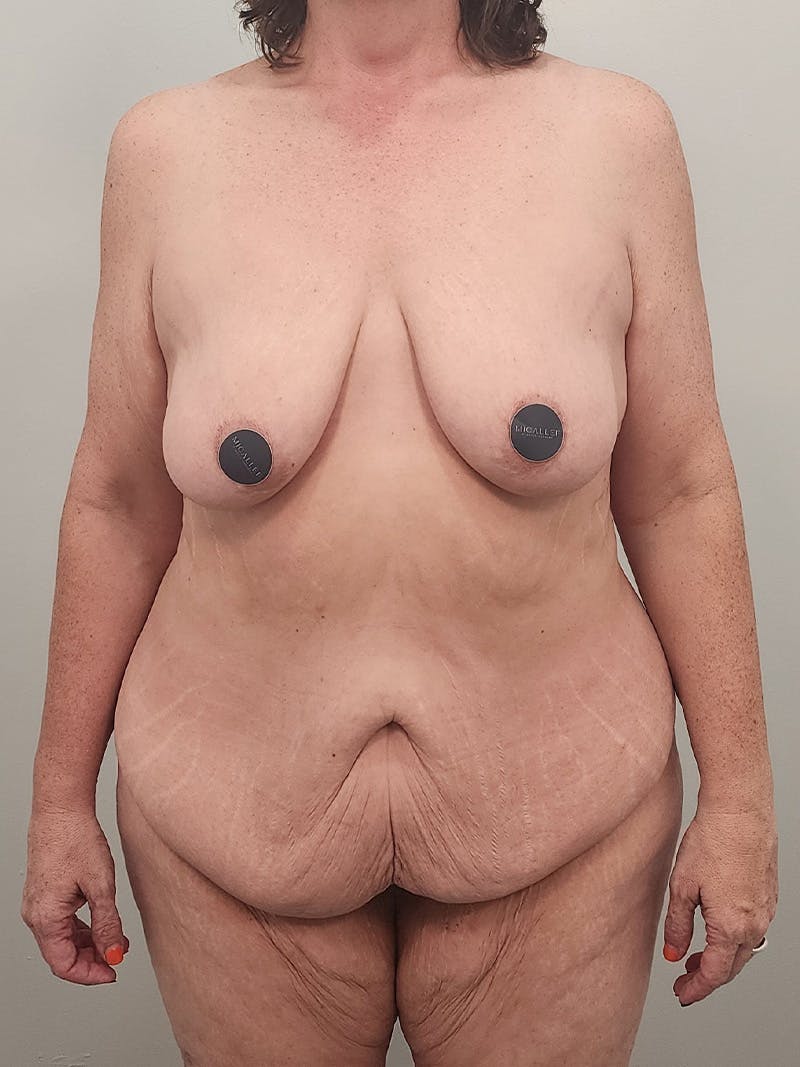 Mommy Makeover Before & After Gallery - Patient 371589 - Image 1