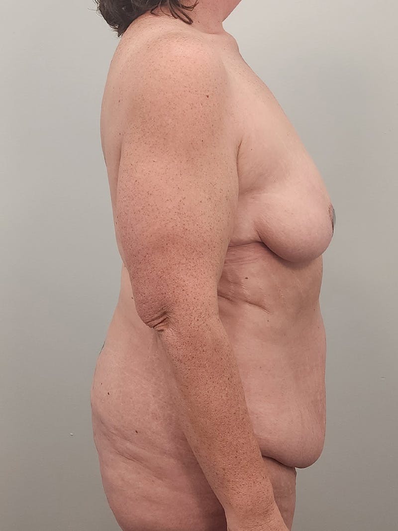 Mommy Makeover Before & After Gallery - Patient 371589 - Image 5