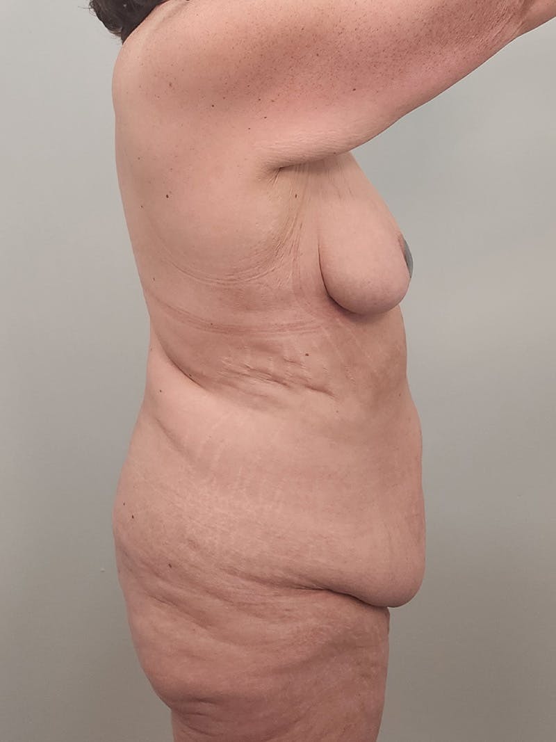 Mommy Makeover Before & After Gallery - Patient 371589 - Image 7