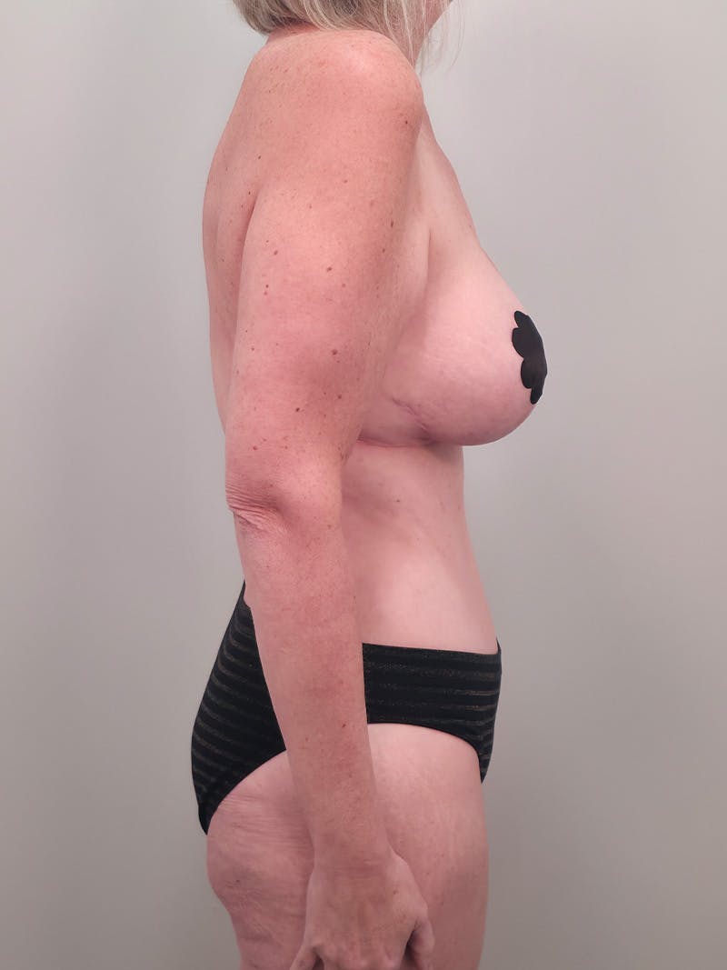 Mommy Makeover Before & After Gallery - Patient 524382 - Image 6