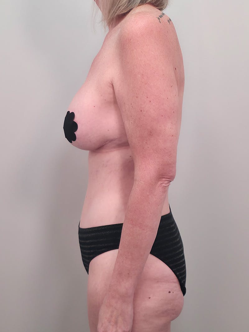 Mommy Makeover Before & After Gallery - Patient 524382 - Image 10