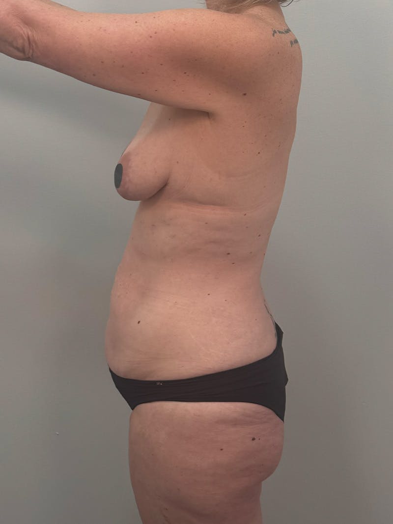 Mommy Makeover Before & After Gallery - Patient 524382 - Image 11