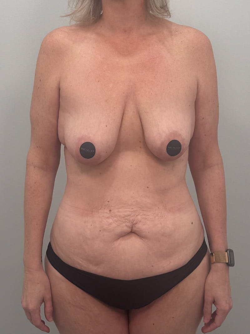 Mommy Makeover Before & After Gallery - Patient 524382 - Image 1