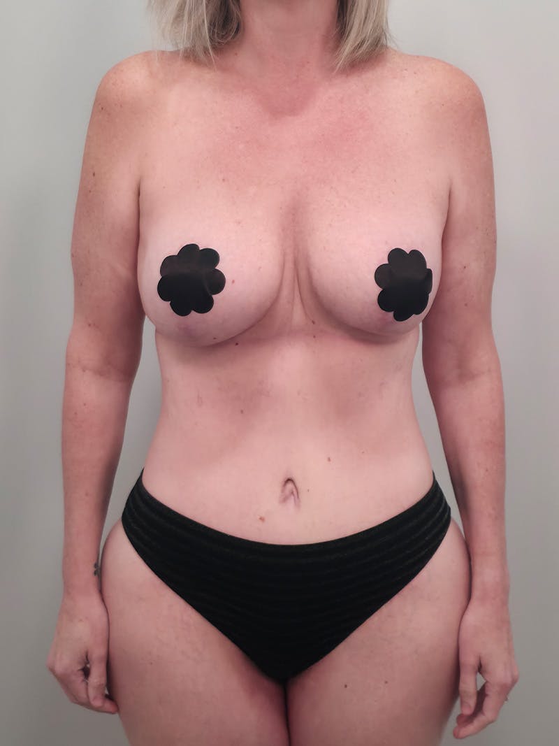 Mommy Makeover Before & After Gallery - Patient 524382 - Image 2