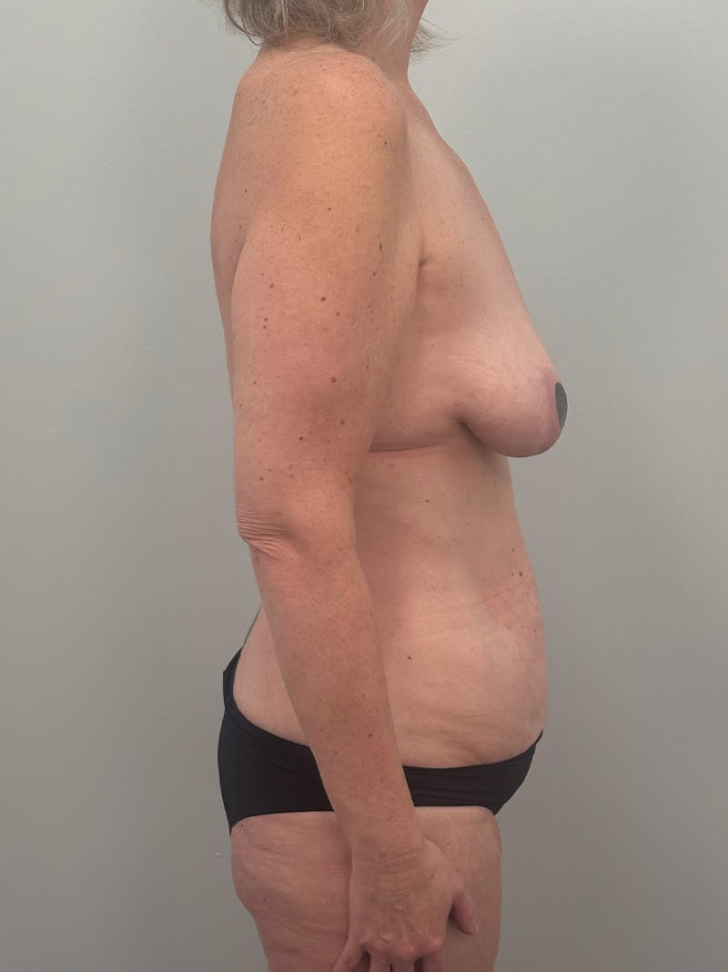 Mommy Makeover Before & After Gallery - Patient 524382 - Image 5