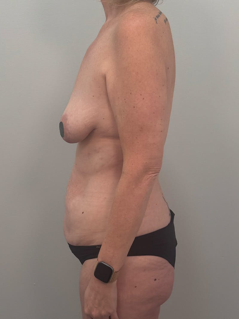 Mommy Makeover Before & After Gallery - Patient 524382 - Image 9