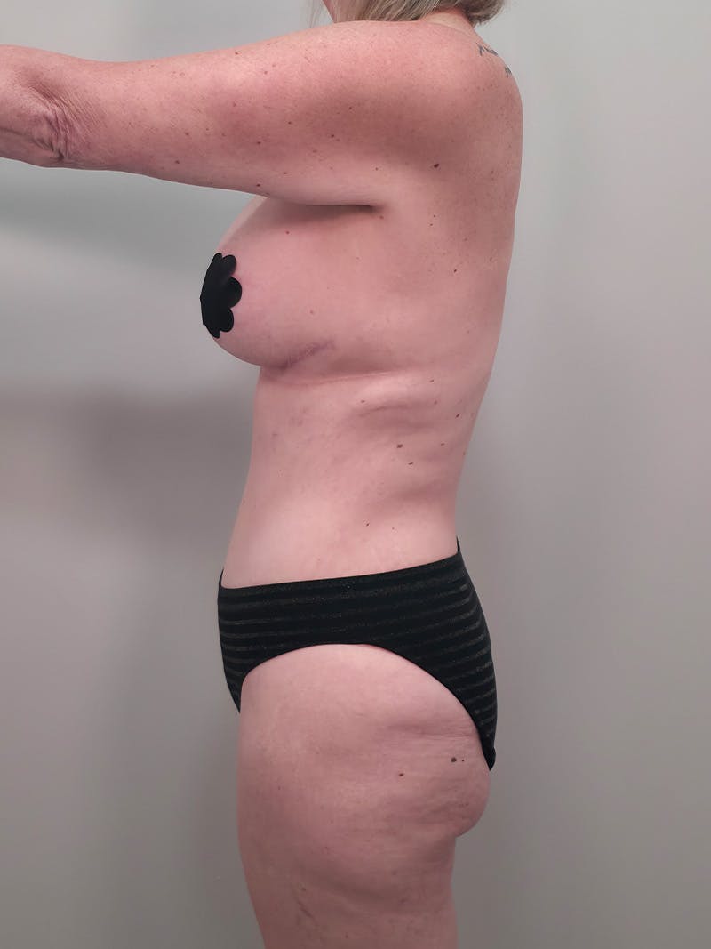 Mommy Makeover Before & After Gallery - Patient 524382 - Image 12