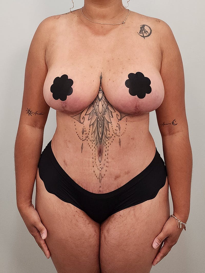 Mommy Makeover Before & After Gallery - Patient 125319 - Image 2