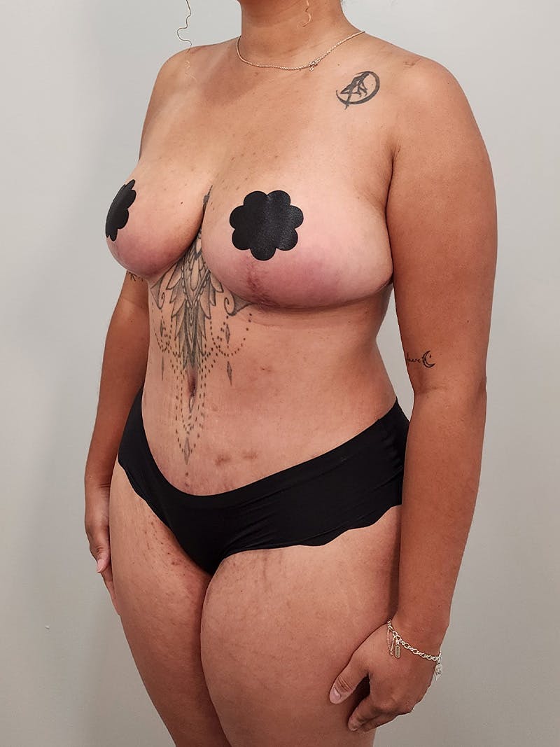 Mommy Makeover Before & After Gallery - Patient 125319 - Image 10