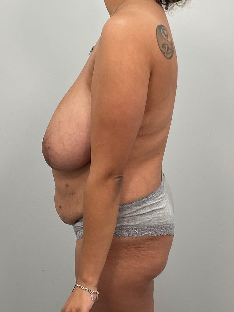 Mommy Makeover Before & After Gallery - Patient 125319 - Image 11