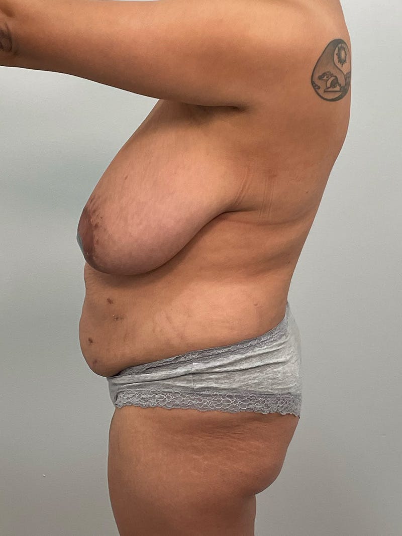 Mommy Makeover Before & After Gallery - Patient 125319 - Image 13