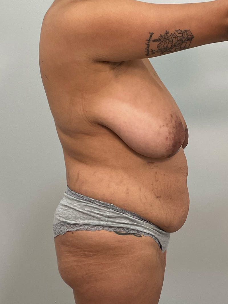 Mommy Makeover Before & After Gallery - Patient 125319 - Image 7