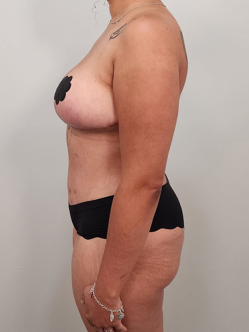 Mommy Makeover Before & After Gallery - Patient 125319 - Image 12