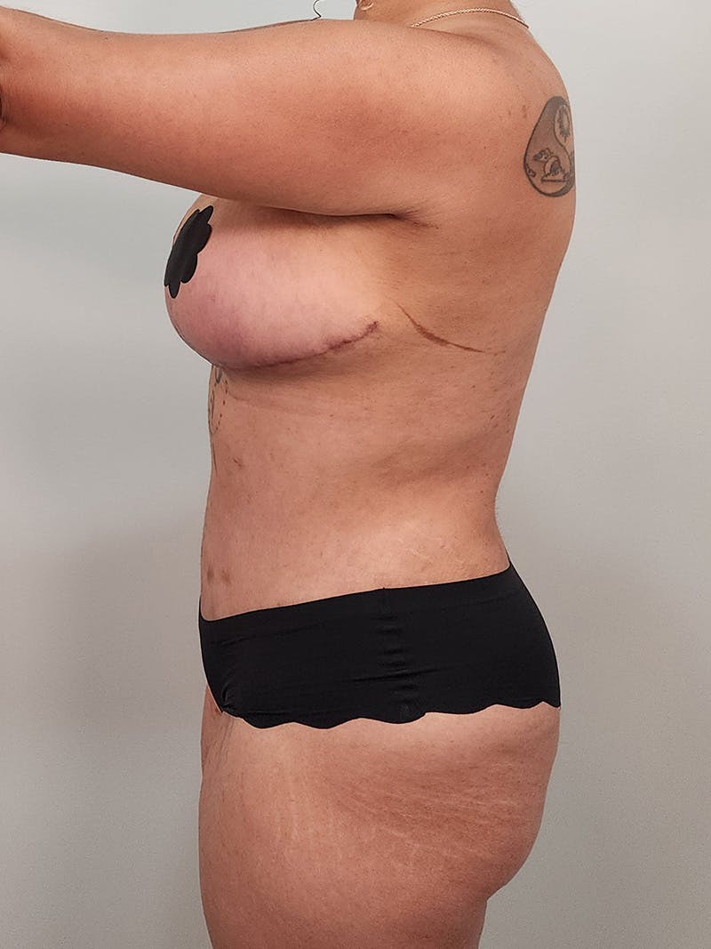 Mommy Makeover Before & After Gallery - Patient 125319 - Image 14