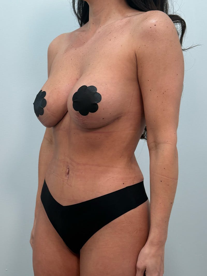 Mommy Makeover Before & After Gallery - Patient 154296 - Image 8