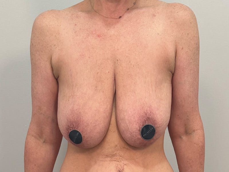 Breast Augmentation-Mastopexy Before & After Gallery - Patient 250724 - Image 1