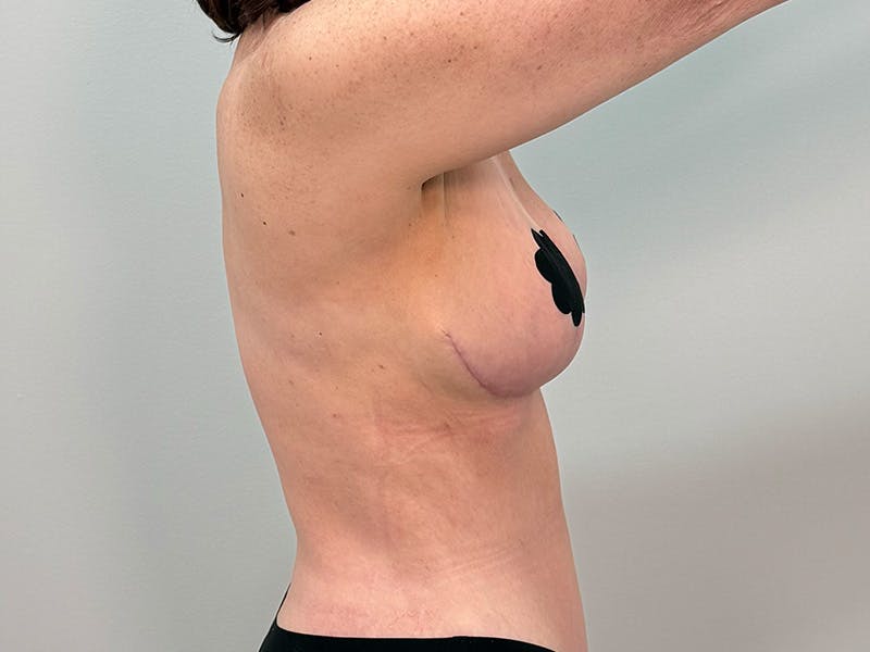 Breast Augmentation-Mastopexy Before & After Gallery - Patient 250724 - Image 8