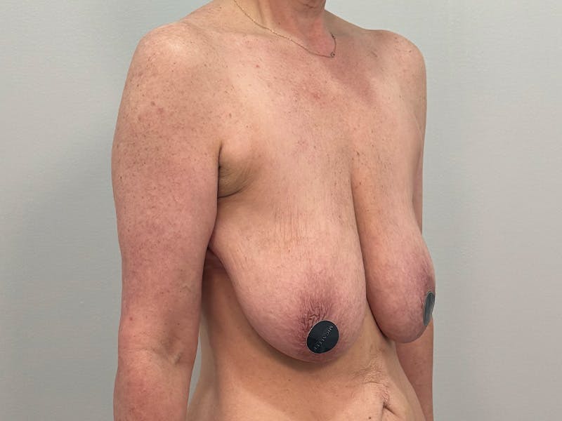 Breast Augmentation-Mastopexy Before & After Gallery - Patient 250724 - Image 3