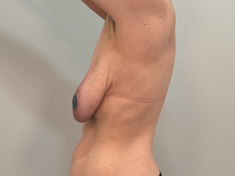 Breast Augmentation-Mastopexy Before & After Gallery - Patient 250724 - Image 11