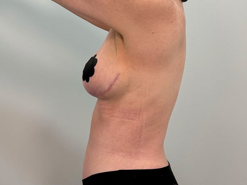 Breast Augmentation-Mastopexy Before & After Gallery - Patient 250724 - Image 12