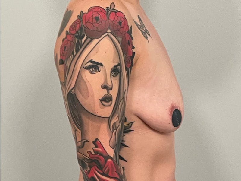 Breast Augmentation-Mastopexy Before & After Gallery - Patient 224811 - Image 5