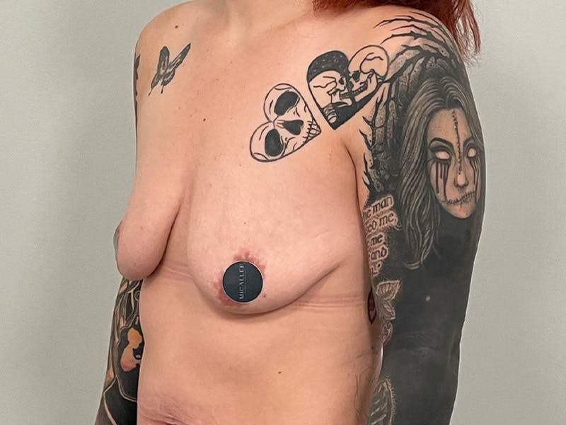 Breast Augmentation-Mastopexy Before & After Gallery - Patient 224811 - Image 9