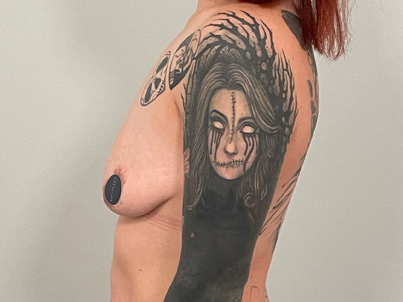 Breast Augmentation-Mastopexy Before & After Gallery - Patient 224811 - Image 11