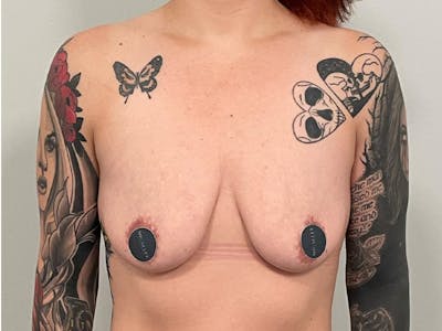 Breast Augmentation-Mastopexy Before & After Gallery - Patient 224811 - Image 1