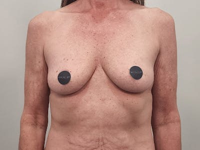Breast Augmentation-Mastopexy Before & After Gallery - Patient 940949 - Image 1