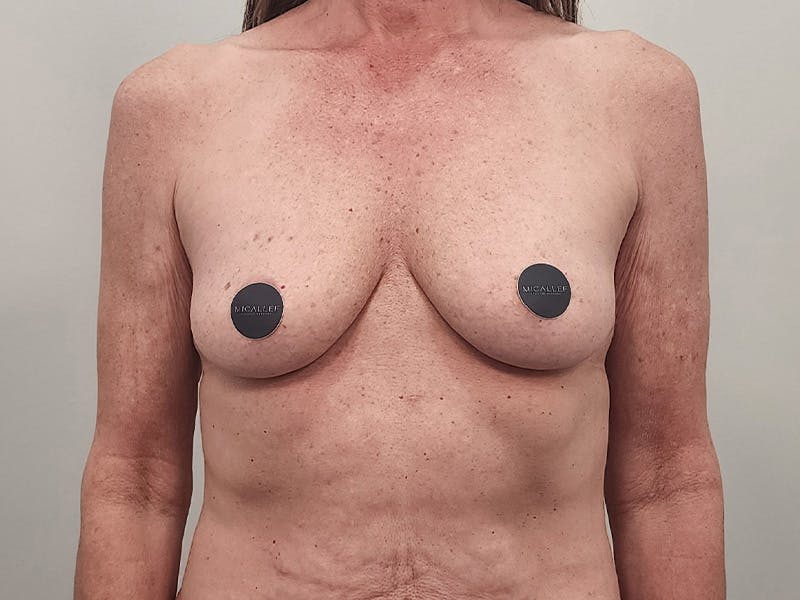 Breast Augmentation-Mastopexy Before & After Gallery - Patient 940949 - Image 1