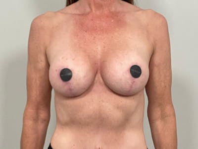 Breast Augmentation-Mastopexy Before & After Gallery - Patient 940949 - Image 2