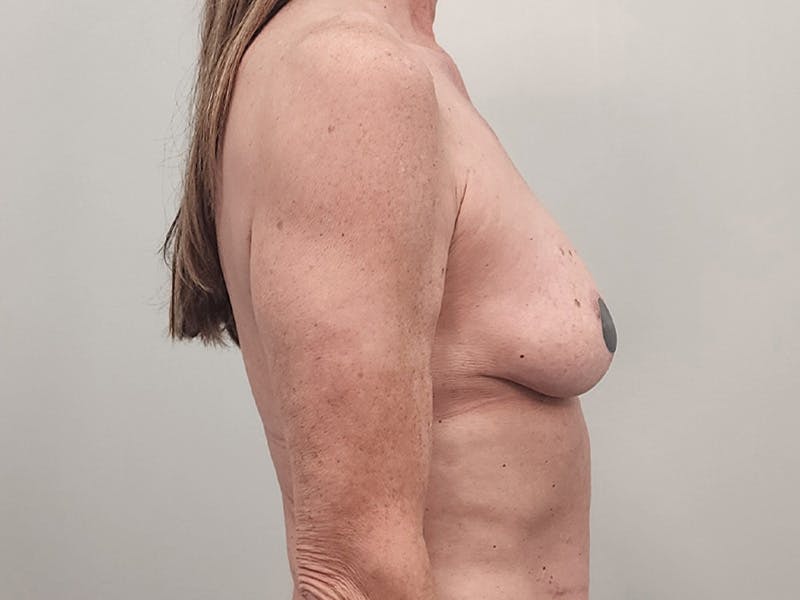 Breast Augmentation-Mastopexy Before & After Gallery - Patient 940949 - Image 5