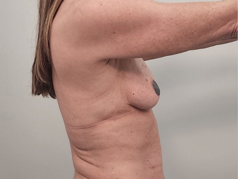 Breast Augmentation-Mastopexy Before & After Gallery - Patient 940949 - Image 7