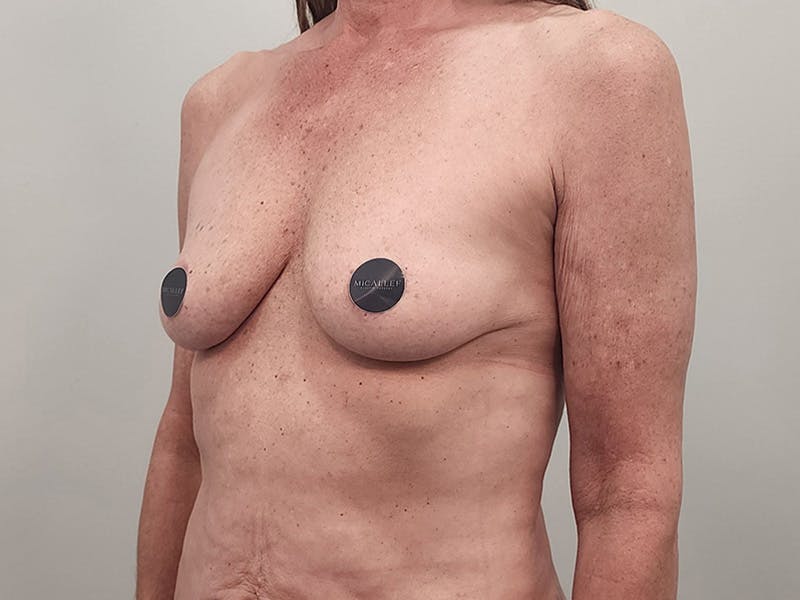 Breast Augmentation-Mastopexy Before & After Gallery - Patient 940949 - Image 9