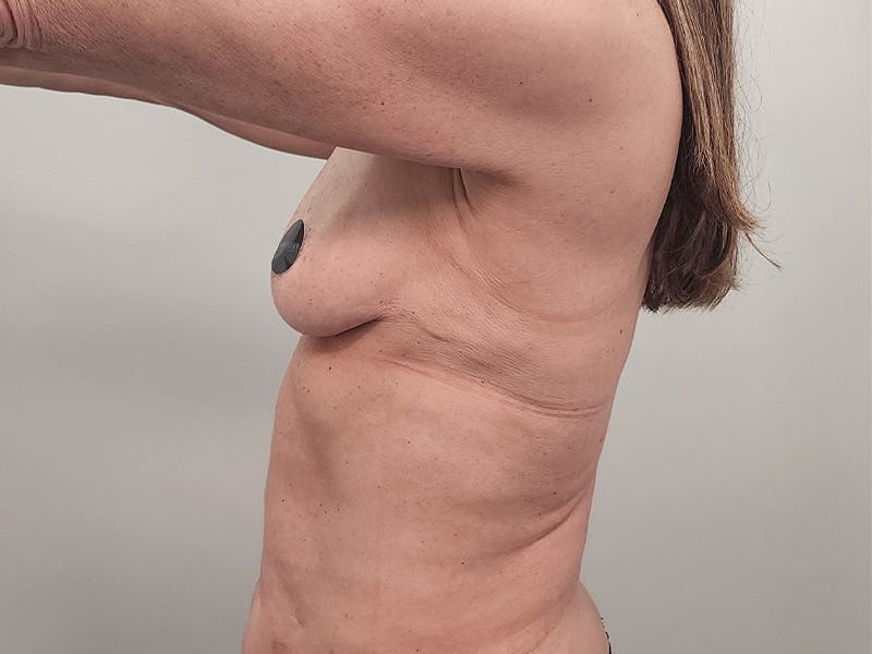 Breast Augmentation-Mastopexy Before & After Gallery - Patient 940949 - Image 13