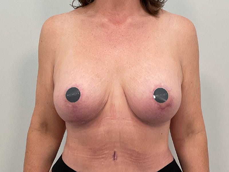 Breast Augmentation-Mastopexy Before & After Gallery - Patient 204820 - Image 2