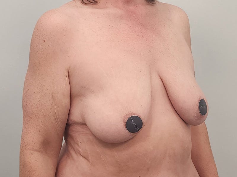 Breast Augmentation-Mastopexy Before & After Gallery - Patient 204820 - Image 3