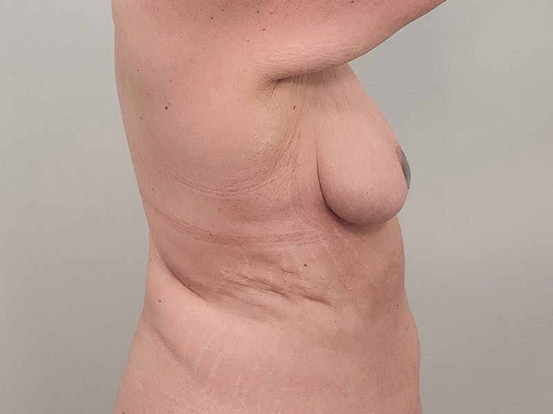 Breast Augmentation-Mastopexy Before & After Gallery - Patient 204820 - Image 7