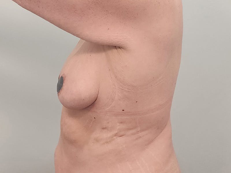 Breast Augmentation-Mastopexy Before & After Gallery - Patient 204820 - Image 13