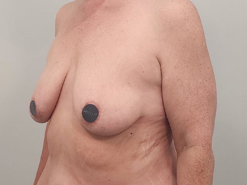 Breast Augmentation-Mastopexy Before & After Gallery - Patient 204820 - Image 9