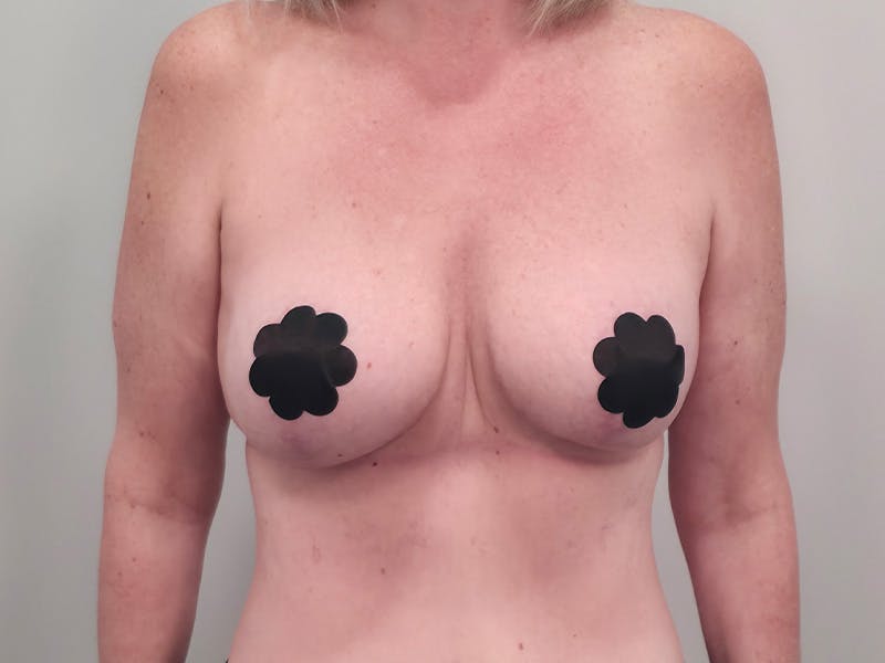 Breast Augmentation-Mastopexy Before & After Gallery - Patient 366909 - Image 2