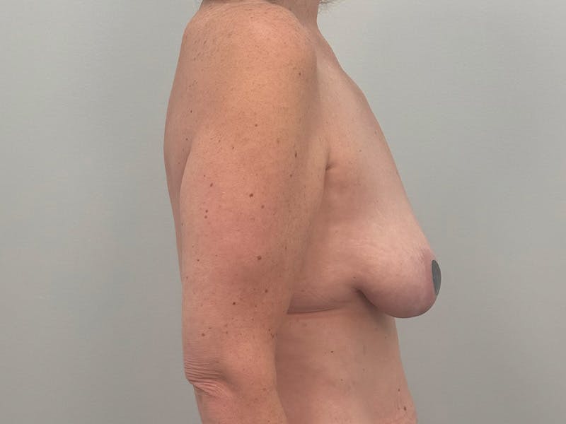 Breast Augmentation-Mastopexy Before & After Gallery - Patient 366909 - Image 5