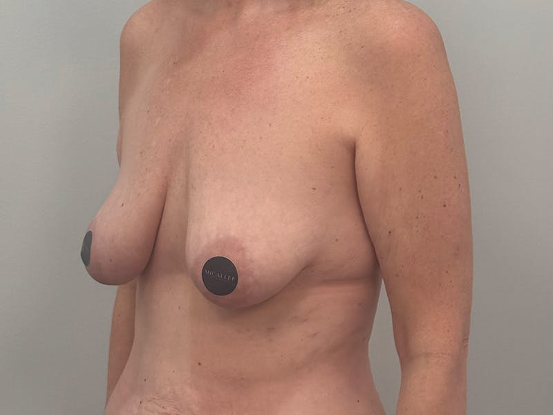 Breast Augmentation-Mastopexy Before & After Gallery - Patient 366909 - Image 7